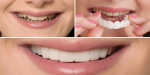 اسنپ آن اسمایل (لمینیت متحرک) snap on smile