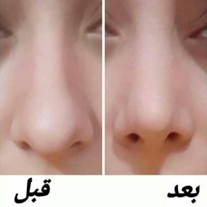 چسب لیفت بینی